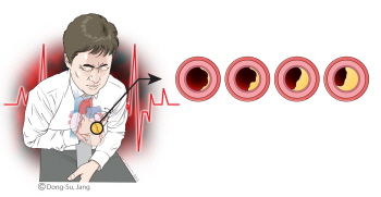 심혈관 질환 발생 막으려면 체온 유지 잘 해야(이미지 출처=세브란스, 일러스트 작가 장동수)
